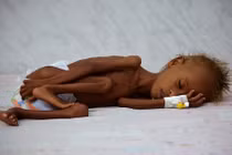 Loạt hình đầy ám ảnh về nạn đói ở Yemen