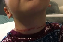 Bé trai 3 tuổi suýt bị thắt cổ đến chết vì lấy thứ này làm vòng cổ