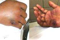 Lý do khiến ngày nào cũng có người bị rắn cắn