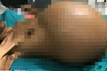 Tưởng bị ma nhập, ai dè đó là khối u nặng 20kg