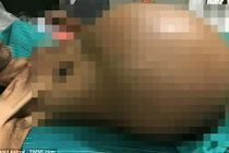 Tưởng bị ma nhập, ai dè đó là khối u nặng 20kg