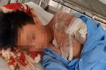 Cha tạt nước sôi khiến con trai bị bỏng nặng: CA Thanh Hoá vào cuộc