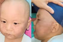 Bảo mẫu đánh bé trai 19 tháng tuổi phải nhập viện