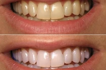 Răng trắng nhanh như sứ với mẹo đơn giản bằng baking soda