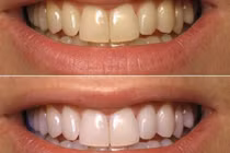 Răng trắng nhanh như sứ với mẹo đơn giản bằng baking soda