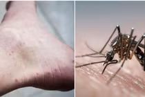 Nóng sốc: Bệnh sốt xuất huyết có thể lây qua đường tình dục