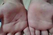 Cô giáo mầm non bị tố dùng vật nhọn đâm vào tay bé trai 5 tuổi