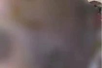 Chỉ vì cả tin, bầu ngực 1 phụ nữ ở Vĩnh Long biến dạng đáng sợ 