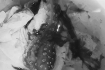 Xấu hổ không đến bệnh viện sớm, cô gái phải lên bàn mổ lấy bao cao su 