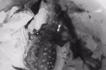 Xấu hổ không đến bệnh viện sớm, cô gái phải lên bàn mổ lấy bao cao su 