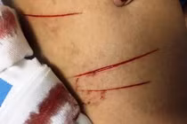 Hoảng hốt vì kẻ biến thái rạch đùi, đâm kim tiêm phụ nữ