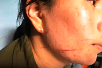 Gia cảnh bi đát của người phụ nữ bị chém, cướp vé số