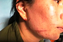 Gia cảnh bi đát của người phụ nữ bị chém, cướp vé số