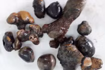 Sốc với "đống" sỏi san hô mọc nhánh trong thận người đàn ông