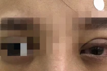 Mắt mờ, sưng nề sau nhấn mí, cô gái hoảng hồn khi bác sĩ lấy ra vật này