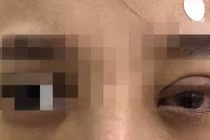 Mắt mờ, sưng nề sau nhấn mí, cô gái hoảng hồn khi bác sĩ lấy ra vật này