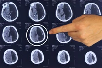 Người đàn ông sống 60 năm mà chỉ có “một nửa” bộ não