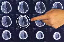 Người đàn ông sống 60 năm mà chỉ có “một nửa” bộ não