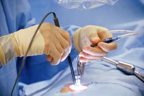 Hút mỡ bụng, cô gái 33 tuổi tử vong ngay trên bàn mổ