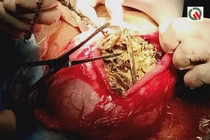 Mắc bệnh lạ cô gái nuốt trọn số trang sức hơn 1,5 tỷ 