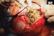 Mắc bệnh lạ cô gái nuốt trọn số trang sức hơn 1,5 tỷ 