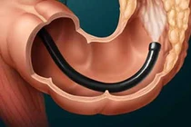 Cách giúp phát hiện ung thư đại tràng sớm