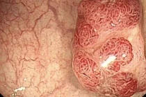 Polyp đường ruột có phát triển thành ung thư ruột kết?