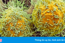 3 yếu tố gây gia tăng số ca ung thư gan 