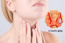 70% người ung thư tuyến giáp có bố, mẹ, anh chị em từng mắc 