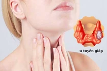 70% người ung thư tuyến giáp có bố, mẹ, anh chị em từng mắc 