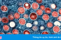 Người nhiễm virus Mpox gây bệnh đậu mùa khỉ nên đi xét nghiệm HIV