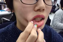 Những thói quen làm tăng nguy cơ ung thư miệng