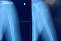 Hy hữu: Que tránh thai đi lạc sâu vào bắp tay