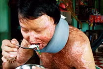  Bất lực trước những tội ác rợn người từ axít?