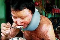  Bất lực trước những tội ác rợn người từ axít?