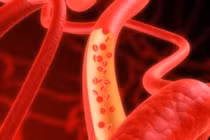 Nguyên nhân dẫn đến tình trạng mỡ máu cao