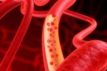 Nguyên nhân dẫn đến tình trạng mỡ máu cao