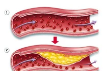 Học cách chung sống với bệnh mỡ máu, mỡ gan, tim mạch