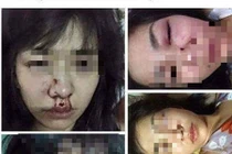 Ẩn tình vợ xinh đẹp bị chồng đánh bầm tím mặt mày