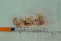 Suýt mất lỗ mũi vì silicon hóa thạch