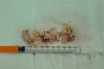 Suýt mất lỗ mũi vì silicon hóa thạch