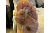 Đi chân trần ở phòng tập gym, nổi mụn cóc suýt mất chi