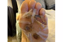 Đi chân trần ở phòng tập gym, nổi mụn cóc suýt mất chi