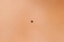 6 nốt ruồi mang lại phúc lộc cả đời cho chủ nhân