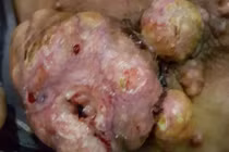 Sát thủ 1000 đồng và căn bệnh ung thư kinh hoàng