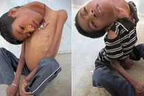 Ấn Độ: Sốc với cậu bé có thể gập ngược đầu