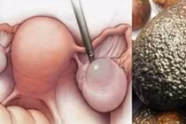 Nói không với ung thư tử cung khi ăn cái này trong ngày “đèn đỏ"