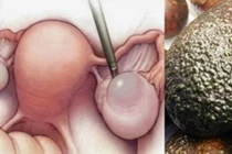 Nói không với ung thư tử cung khi ăn cái này trong ngày “đèn đỏ"