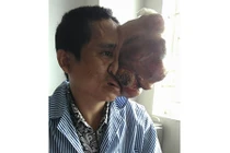 Người đàn ông biến dạng khuôn mặt vì khối u khổng lồ 
