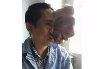 Người đàn ông biến dạng khuôn mặt vì khối u khổng lồ 